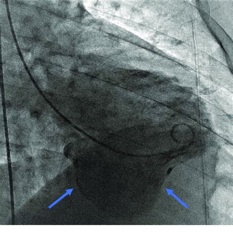 left ventricular angiogram results